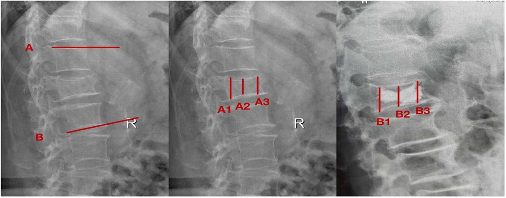 Three spinal X-rays with red lines illustrating measurements. The first image has two horizontal lines labeled A and B. The second image shows three vertical lines labeled A1, A2, and A3. The third image displays three vertical lines labeled B1, B2, and B3. Each image has a marker labeled \