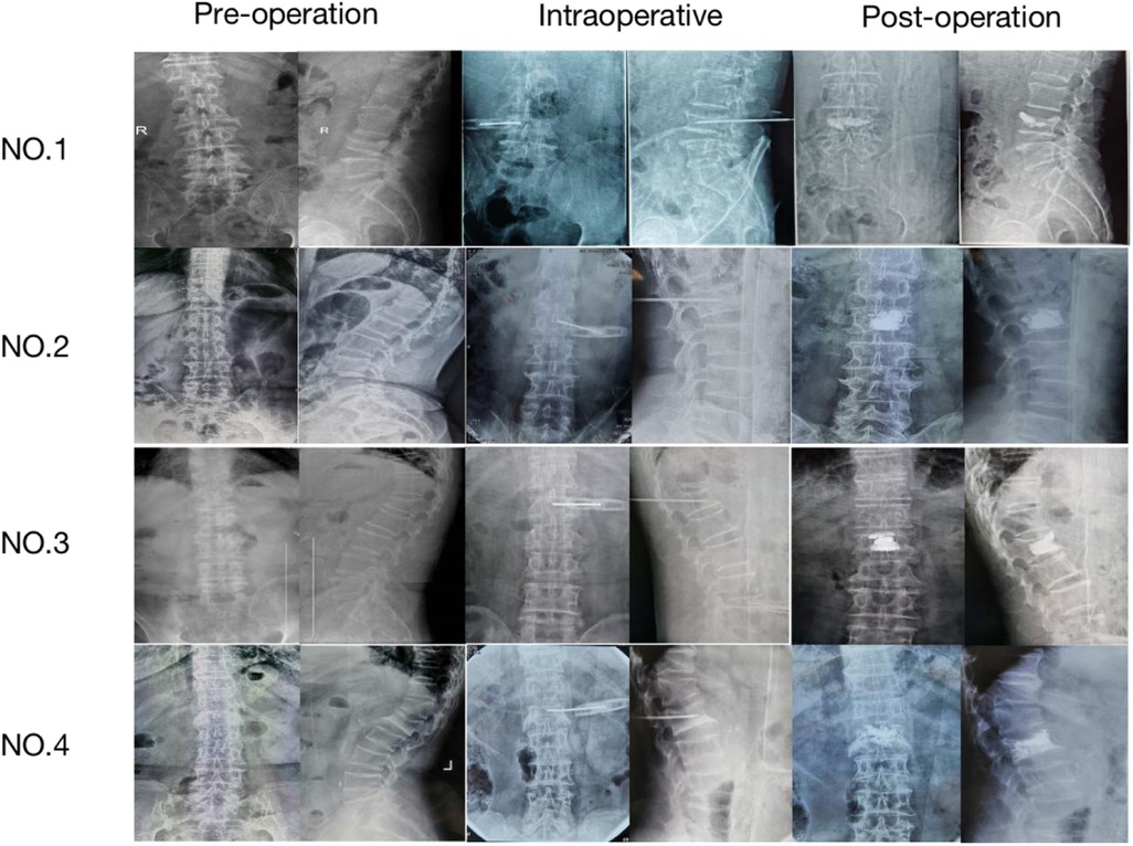 X-ray images show spinal views for four patients, labeled NO.1 to NO.4, across three stages: pre-operation, intraoperative, and post-operation. Each row represents a patient with corresponding spinal images in anterior and lateral orientations at each stage to illustrate the changes in spinal alignment and surgical interventions.