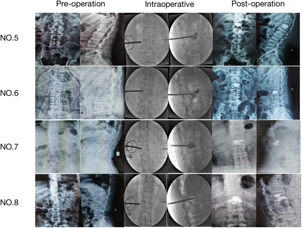 Sequential X-ray images showing spine conditions for cases NO.5 to NO.8 in three stages: pre-operation, intraoperative, and post-operation. Each row represents a patient, showing changes before, during, and after surgical procedures on the spine. Intraoperative images display medical instruments and markers.
