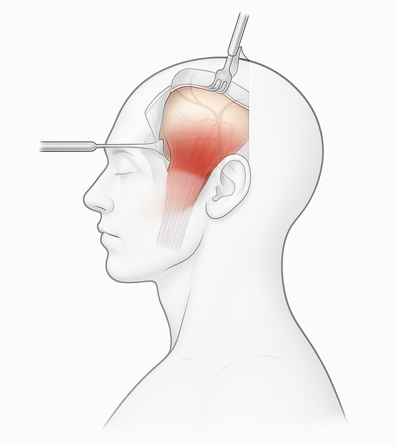 Illustration of a side view of a human head showing a surgical procedure. The image highlights the temporalis muscle, which is exposed and colored in red, and being manipulated with surgical tools.