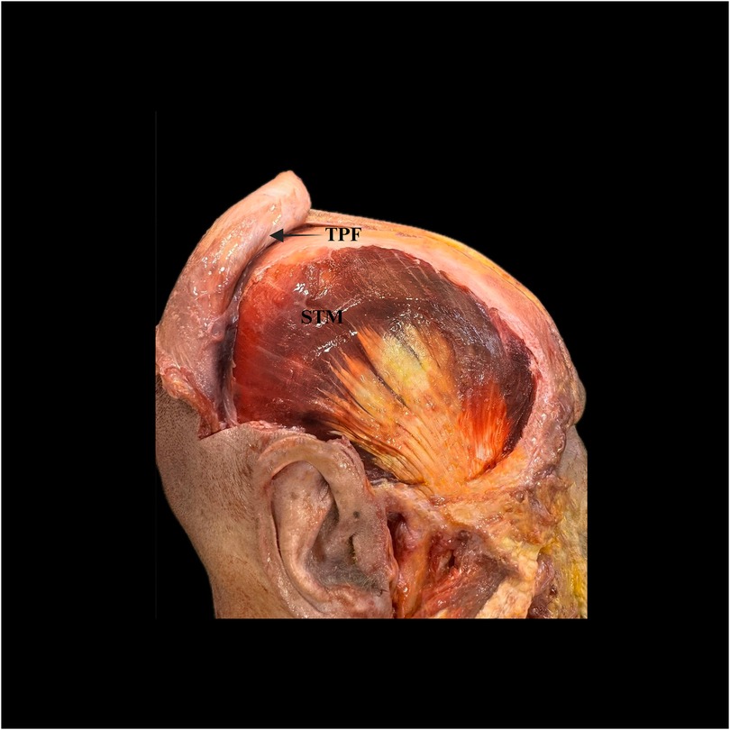 Dissection image of the human temporal region showing the temporoparietal fascia (TPF) and superficial temporal muscle (STM). The layers and muscle fibers are visible with labels indicating their positions.