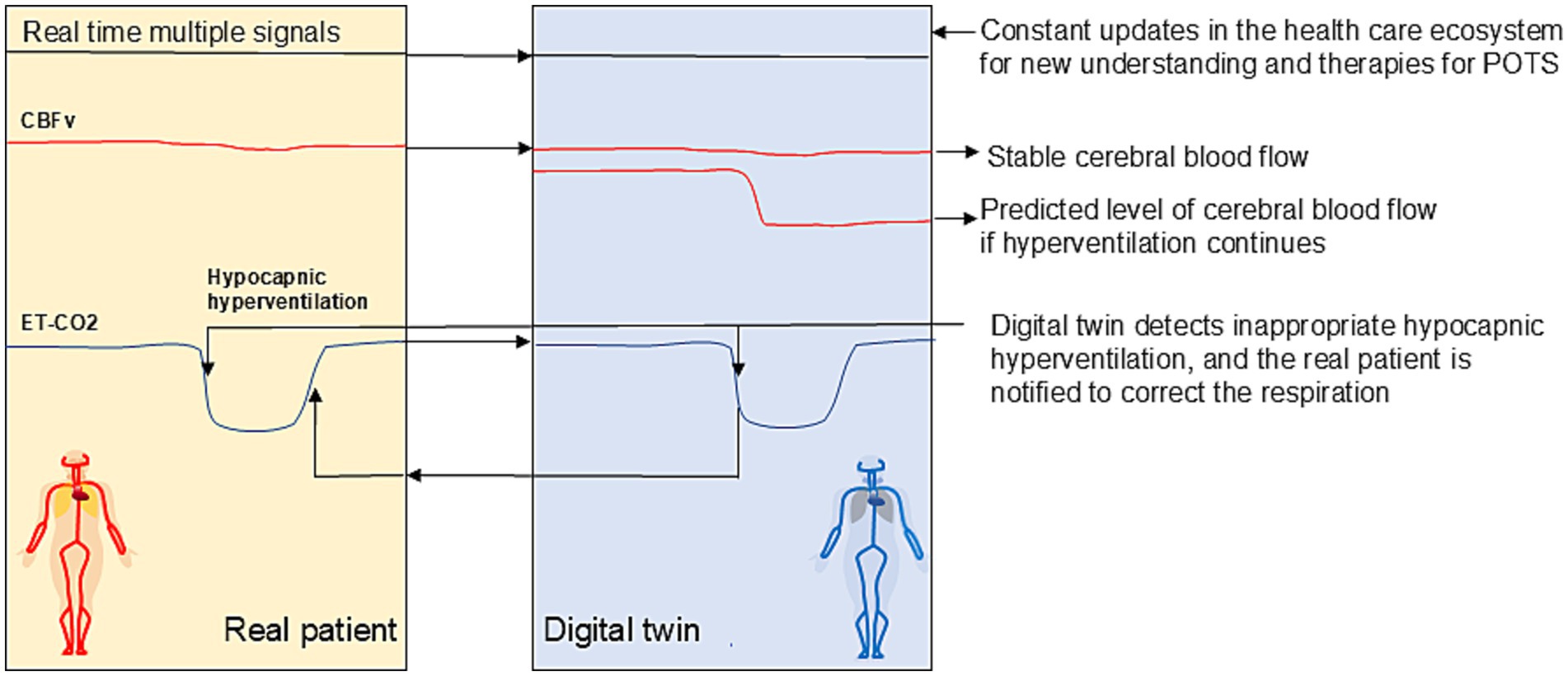 Diagram showcasing a digital twin-based system forthe detection and prevention of symptomatic cerebral hypoperfusion inpostural tachycardia syndrome (POTS), primarily integrating datafrom capnography and cerebral blood flow.