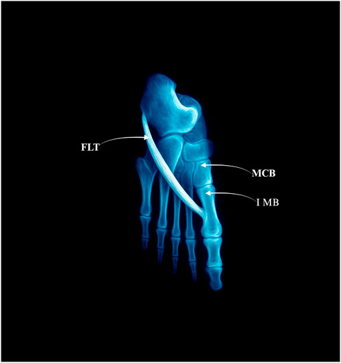 X-ray image of a human foot highlighting the long fibular tendon (FLT), metatarsal bone (MCB), and intermediate metatarsal bone (I MB). The bones and tendons are labeled in bright blue against a black background.