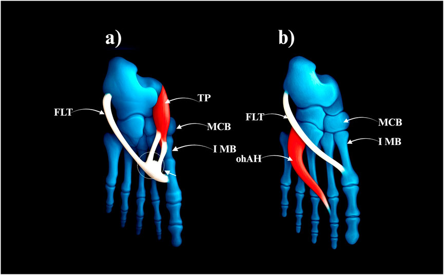 Illustration comparing anatomical features in two scenarios labeled a and b. Both show skeletal structures in blue with muscles in red and tendons in white. Arrows label FLT, TP, MCB, IMB in a, and FLT, MCB, IMB, ohAH in b, indicating specific anatomical parts and their connections.
