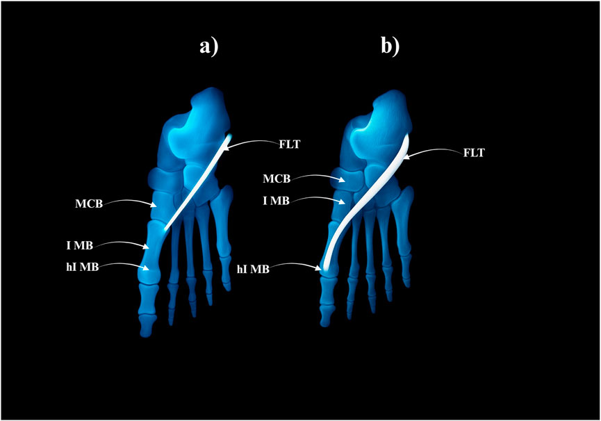 Illustration comparing two labeled foot bone diagrams, marked (a) and (b). Both images show skeletal structures with annotations: FLT, MCB, I MB, and hI MB, likely referring to specific bones or ligaments. Diagram (a) and (b) highlight variations in structure or connection.