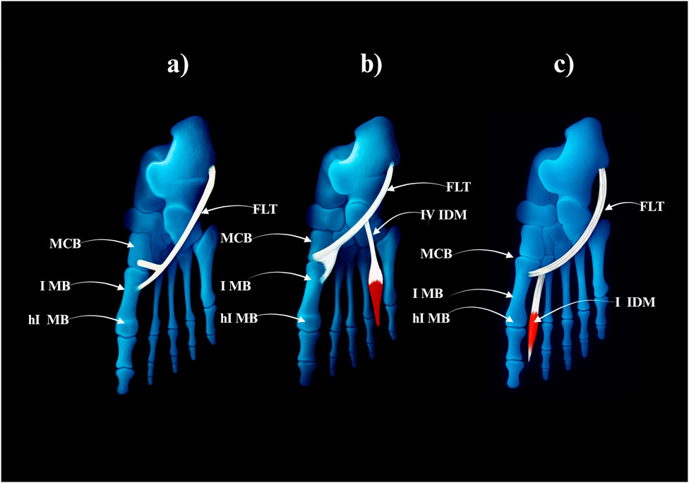 Three-panel illustration showing anatomical structures of a foot. Panel a) highlights FLT, MCB, I MB, and hI MB tendons and muscles. Panel b) includes IV IDM, in addition to previous labels. Panel c) shows FLT and I IDM with a differently angled structure. Blue shades denote bones, red indicates muscle, and white represents tendons.