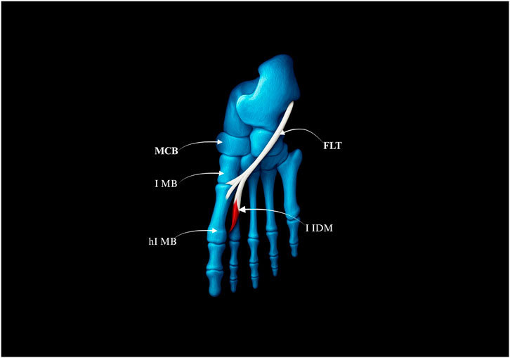 Illustration of a human foot highlighting different parts in labels. The bones are shown in blue with a white tendon and red muscle section. Parts are labeled as MCB, FLT, I MB, hI MB, and I IDM. The diagram focuses on anatomical features.