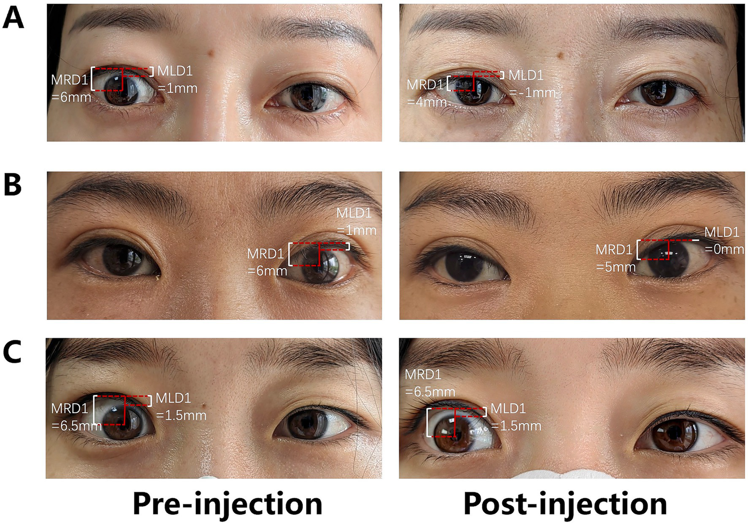 Three sets of pre-injection and post-injection images of eyes labeled A, B, and C. Each set shows measurements: MRD1 and MLD1. A:MRD1 = 6mm pre, 4mm post; MLD1 = 1mm pre, -1mm post. B: MRD1 = 6mm pre, 5mm post; MLD1 = 1mm pre, 0mm post. C: MRD1 = 6.5mm pre and post; MLD1 = 1.5mm pre and post.