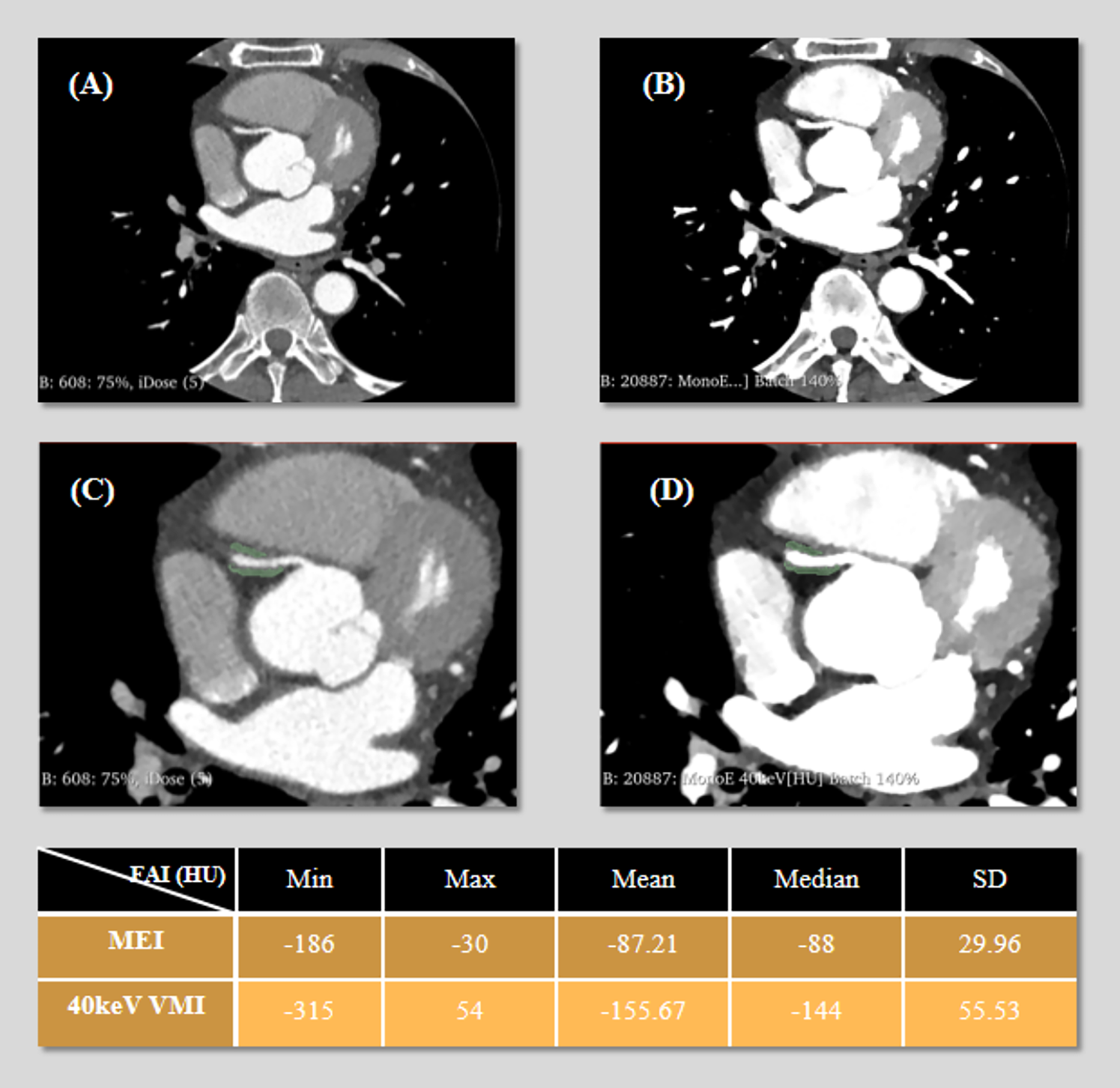 3D Slicer segmentation of pericoronary adipose tissue (PCAT) around the right coronary artery (RCA). The green area represents the segmented volume. (A): Axial mixed-energy images (MEI) of the RCA. (B): 40 keV virtual monoenergetic images (VMI) at the same level. (C): Segment placement on MEI. (D): Same region of interest (ROI) on 40 keV VMI. The following table presents the statistical values ( minimum, maximum, mean, median, and standard deviation) of fat attenuation index (FAI) measured on both MEI and 40 keV VMI.