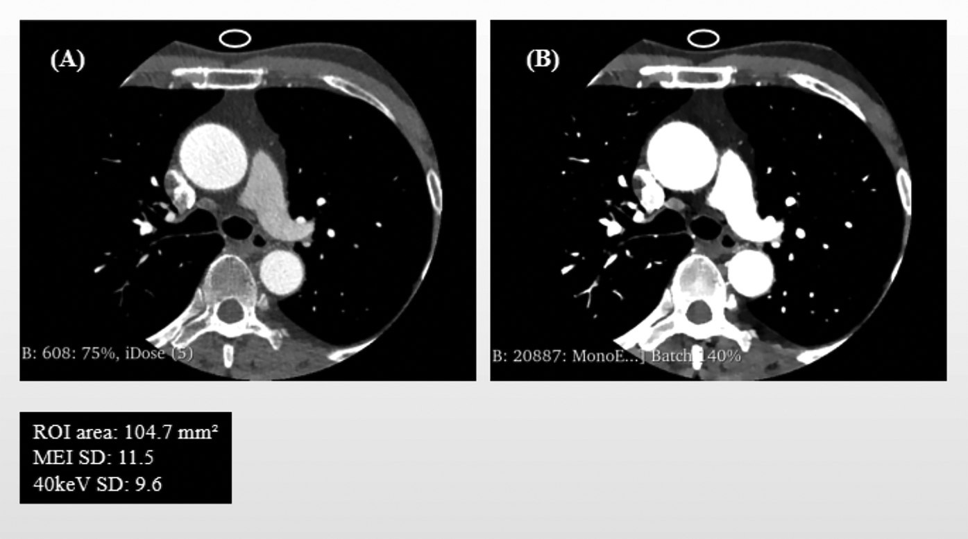 Schematic Illustration of Background Noise standard deviation (SD) and ROI Delineation: mixed-energy images (MEI) vs. 40 keV virtual monoenergetic images (VMI). Panel (A) shows the background noise's region of interest (ROI) in MEI, and Panel (B) displays the same ROI copied onto the corresponding 40 keV VMI.
