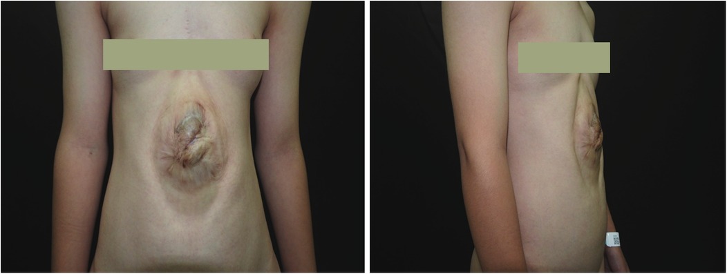Front and side view of a person's torso showing a large, circular scar in the central abdomen area, possibly post-surgical. Skin appears mostly unblemished aside from the scar. Identification details are obscured.
