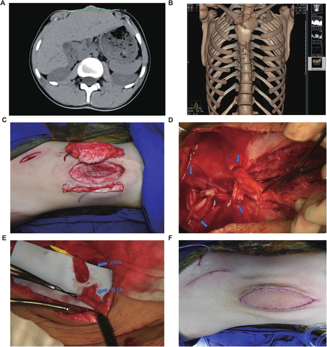 A composite of six medical images. A: CT scan showing an axial view of the abdomen. B: 3D reconstruction of the rib cage and spine. C: Surgical view of exposed abdominal tissue. D: Close-up of exposed blood vessels with arrows indicating key areas. E: Surgical procedure with labeled structures, \