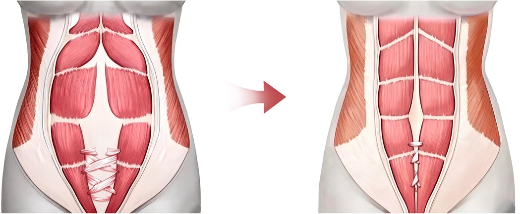 Illustration showing a comparison of abdominal muscles before and after surgical repair. The left side depicts separated muscles, while the right side shows muscles aligned and tightened with sutures, indicating repair.