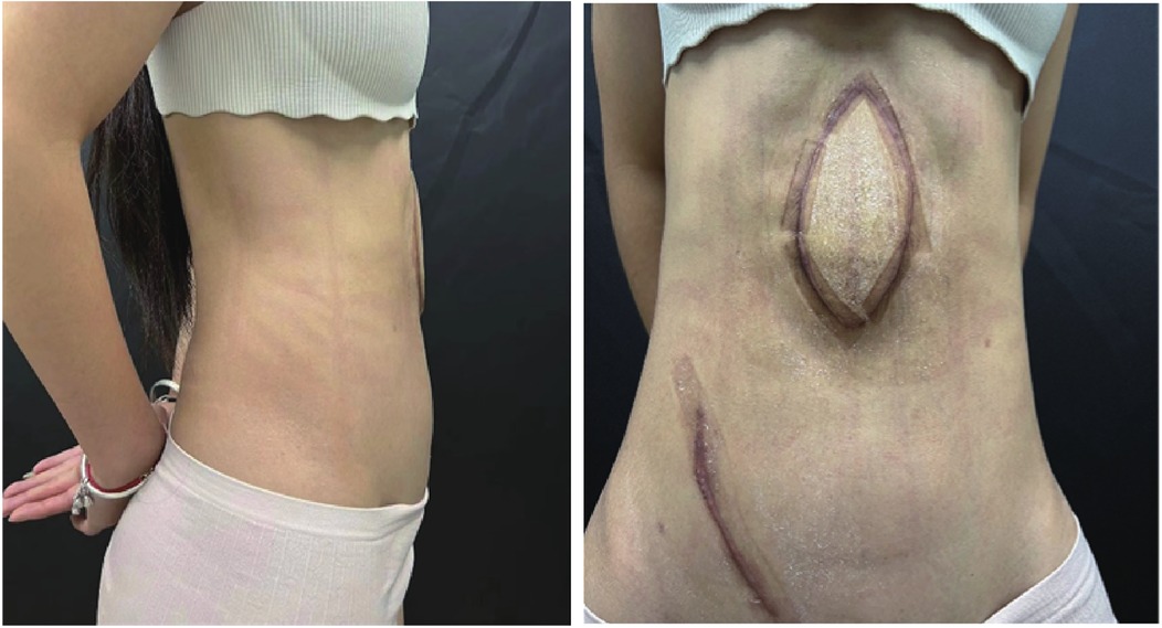 Two side-by-side images show a person’s torso. The left image highlights the side view with a slim waist. The right image features the front view, displaying a large, oval scar on the abdomen and a curved scar below it, both with a reddish tint. The person is wearing a white cropped top and light-colored pants.