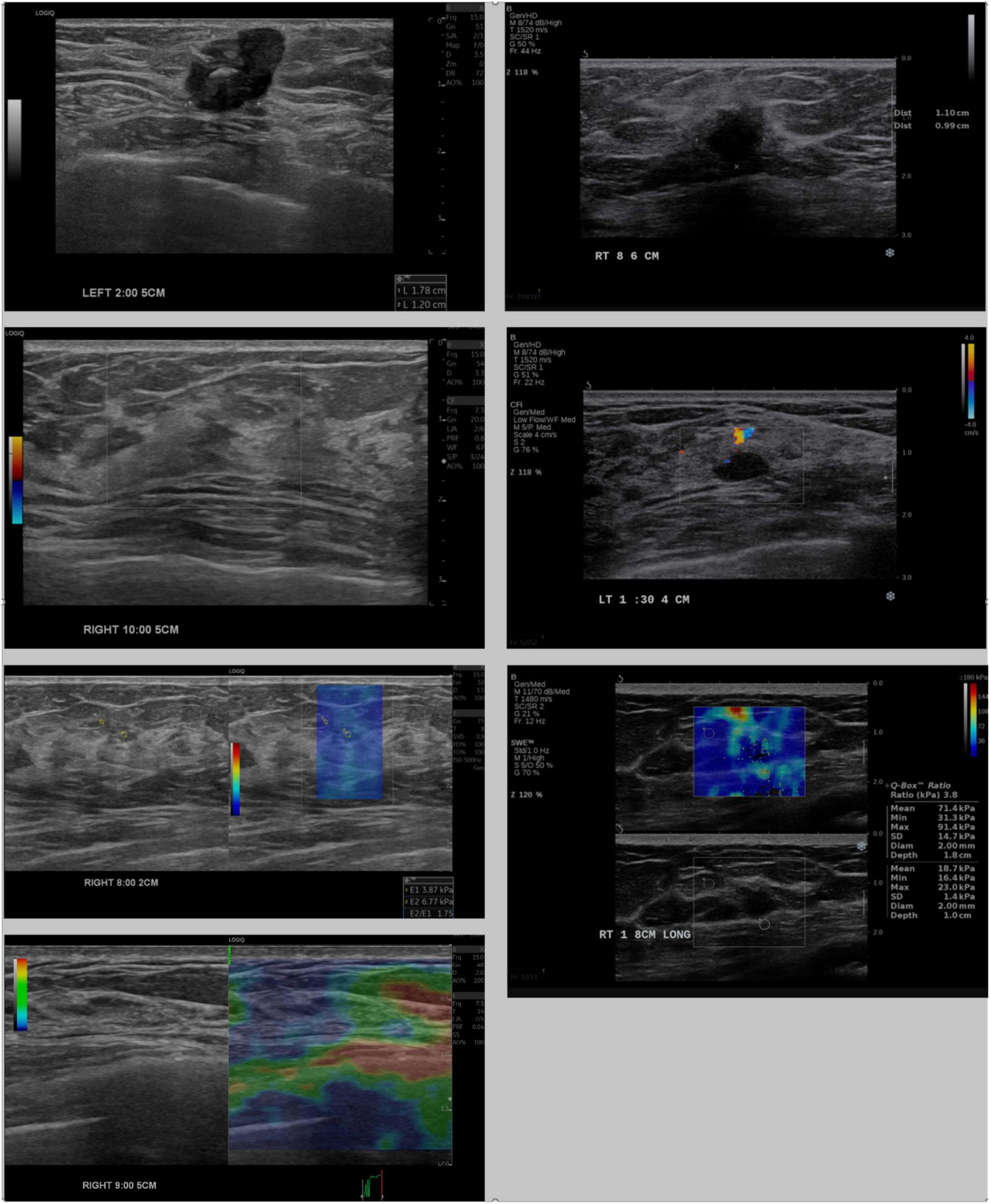Seven ultrasound images display various breast tissue sections, with measurements and color Doppler overlays indicating blood flow. Each image features different angles and cross-sections, annotated with measurements like “LEFT 2.00 5CM” and “RIGHT 10:00 5CM” for positioning.