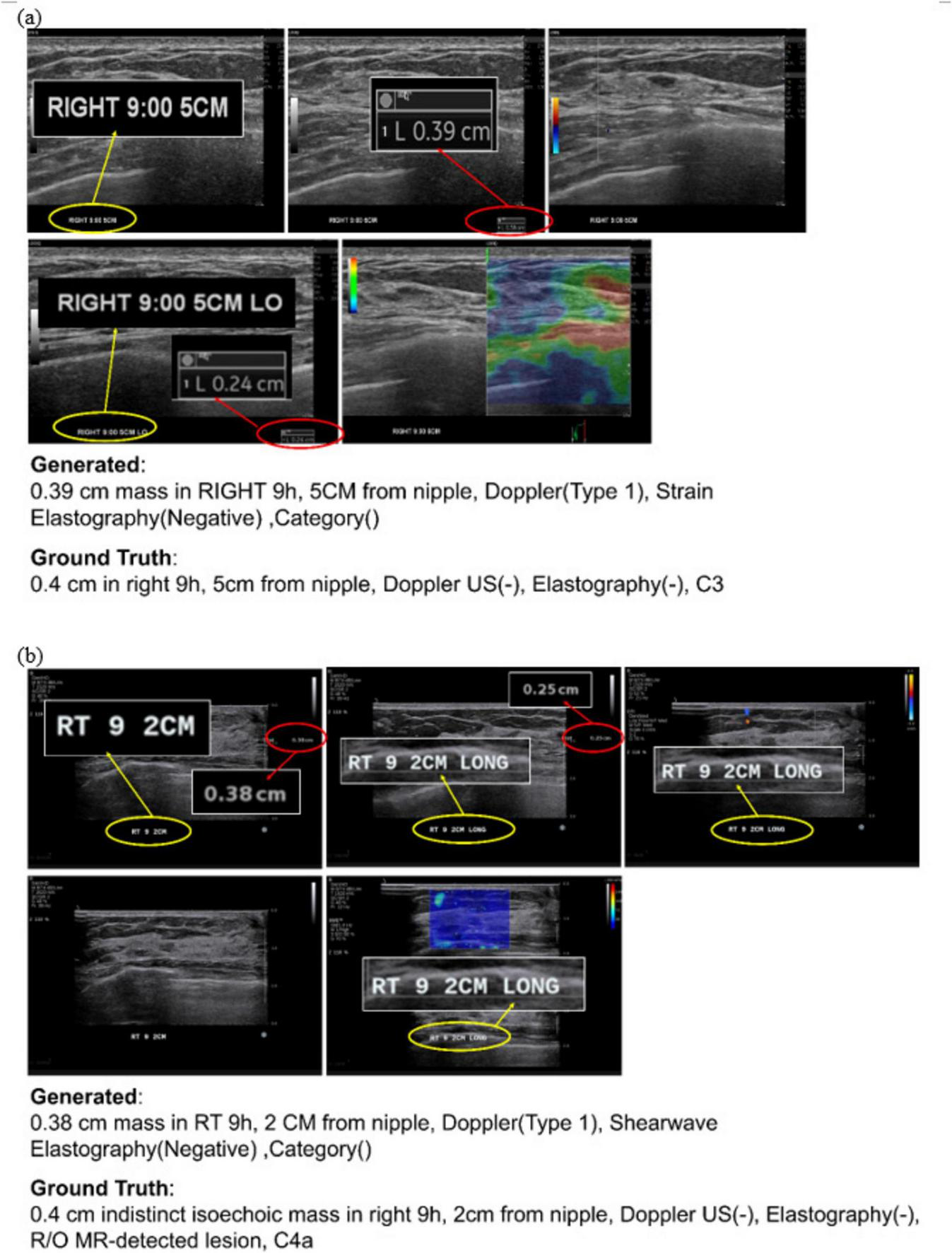 Panel (a) shows ultrasound images with measurements indicating a 0.39 cm mass in the right breast at 9 o’clock, 5 cm from the nipple. Doppler ultrasound is Type 1, strain elastography results are negative. Ground truth confirms these findings, with category C3. Panel (b) displays another set of ultrasound images showing a 0.38 cm mass in the right breast at 9 o’clock, 2 cm from the nipple. Doppler ultrasound is Type 1, shearwave elastography results are negative. Ground truth notes an indistinct isoechoic mass, category C4a.