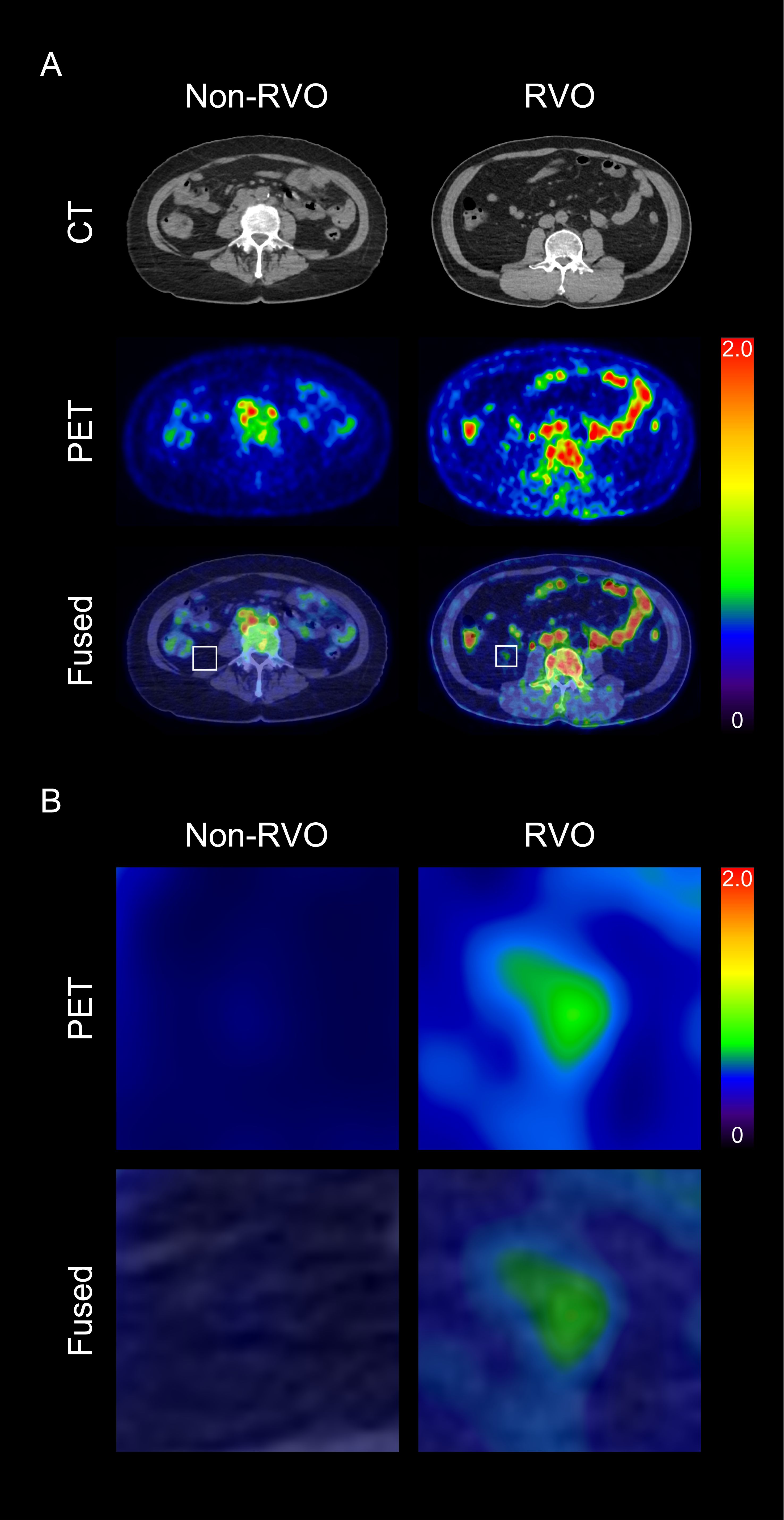 Panel A shows CT, PET, and fused images comparing Non-RVO and RVO. CT images display anatomical structures, PET images highlight metabolic activity with color variations, and fused images combine both modalities. Panel B shows enlarged ET and fused images, illustrating higher activity in RVO, with color scales indicating intensity.
