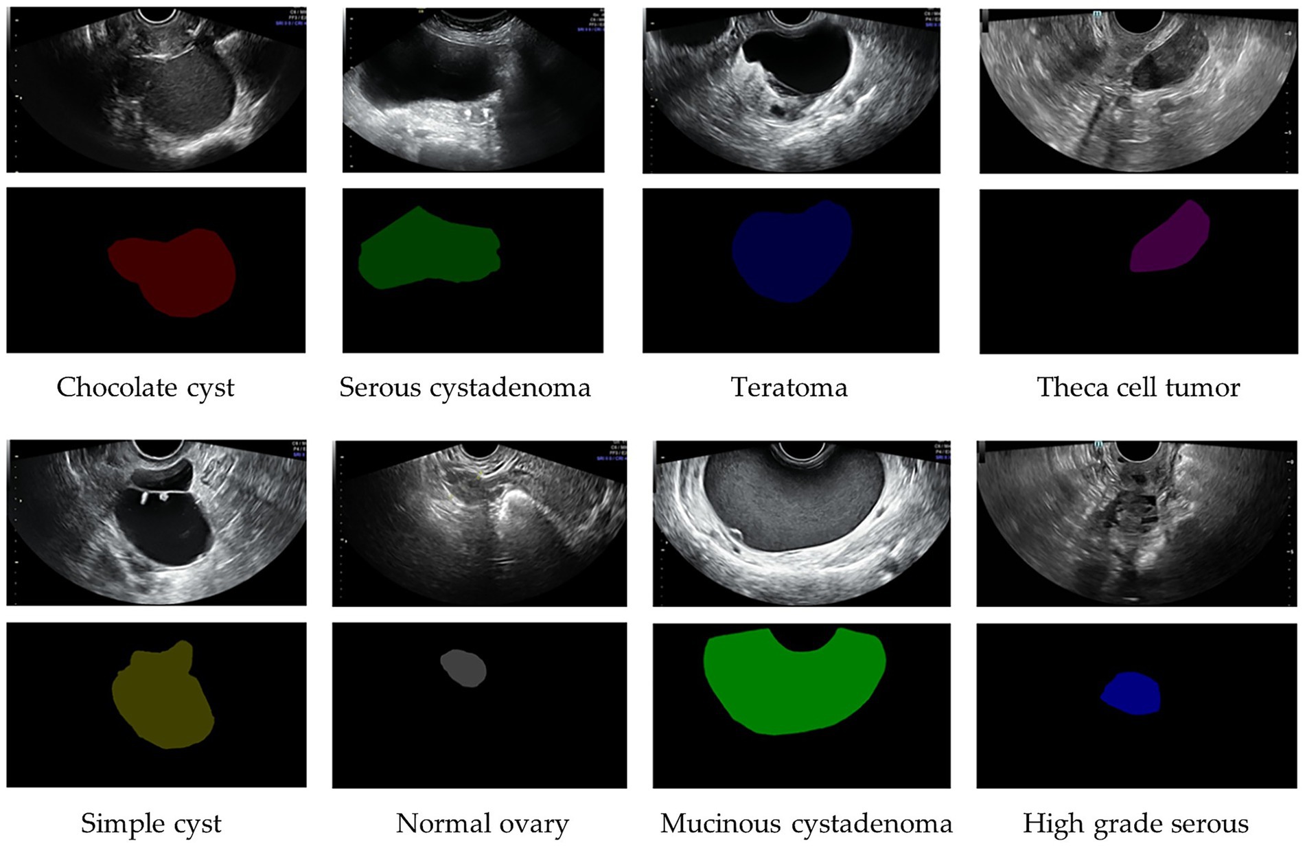Ultrasound images show various ovarian conditions. Top row: Chocolate cyst, Serous cystadenoma, Teratoma, Theca cell tumor. Bottom row: Simple cyst, Normal ovary, Mucinous cystadenoma, High-grade serous. Each is paired with a highlighted contrast shape on a black background.
