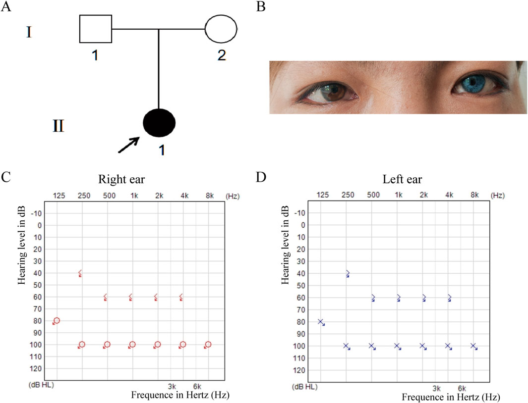 Diagram A shows a simple family pedigree with two generations. Image B displays eyes with heterochromia, one brown and one blue. Graph C shows an audiogram for the right ear, indicating hearing levels across frequencies. Graph D displays a similar audiogram for the left ear, indicating hearing levels across frequencies.