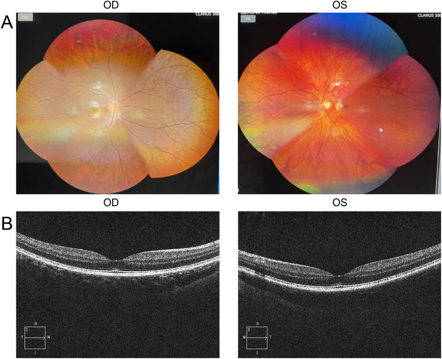 Fundus photographs and OCT scans show the retinas of both eyes. The top row displays the fundus images, revealing vascular patterns and the optic discs. The bottom row shows corresponding OCT scans, illustrating retinal layers and macular contours. The left column represents the right eye (OD) and the right column the left eye (OS).