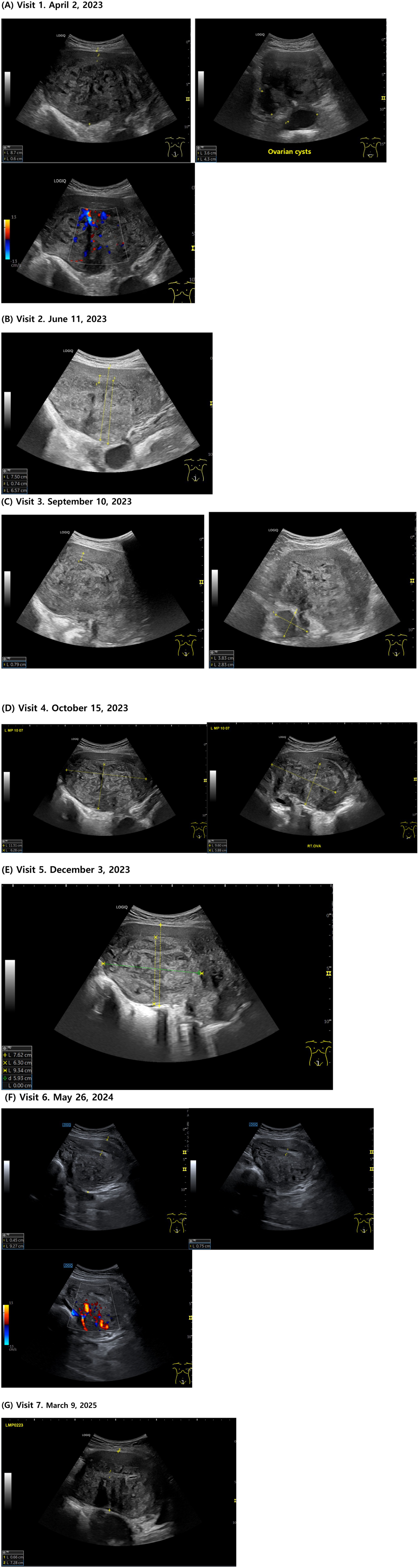 Ultrasound images from two visits. Panel A (April 2, 2023) shows three images: two grayscale scans of the ovary, highlighting ovarian cysts, and a Doppler scan indicating blood flow with red and blue signals. Panel B (June 11, 2023) displays a single grayscale scan, with measurements indicating changes since the first visit. Ultrasound images showing three different visits with measurements marked. Visit 3 on September 10, 2023, displays two images with dimensions of 0.79 cm, 3.83 cm, and 2.83 cm marked. Visit 4 on October 15, 2023, features two images with measurements of 11.13 cm, 6.28 cm, 8.90 cm, and 5.18 cm. Visit 5 on December 3, 2023, shows one image with dimensions of 7.62 cm, 6.50 cm, 9.34 cm, 5.93 cm, and 0.00 cm. Yellow measurements and ultrasound cross-sections are visible. Ultrasound images labeled Visit 6, May 26, 2024, show three panels with measurements and a color Doppler highlighting blood flow. Visit 7, March 9, 2025, presents a single ultrasound image with measurements. Both visits feature diagnostic imaging focusing on specific anatomical areas, marked with scales and annotations.