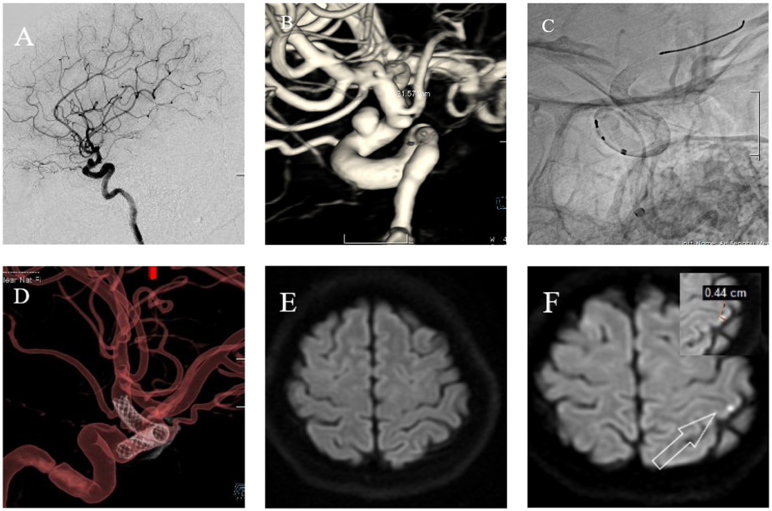A collage of six medical images showing various brain imaging techniques. Image A: Angiogram of cerebral arteries. Image B: 3D reconstruction of cerebral vasculature. Image C: Angiographic view of a medical device within an artery. Image D: 3D model illustrating vessel pathways. Image E: An MRI scan showing a normal brain. Image F: MRI scan highlighting a specific area with a measurement insert marked 0.44 cm, indicating a point of interest.