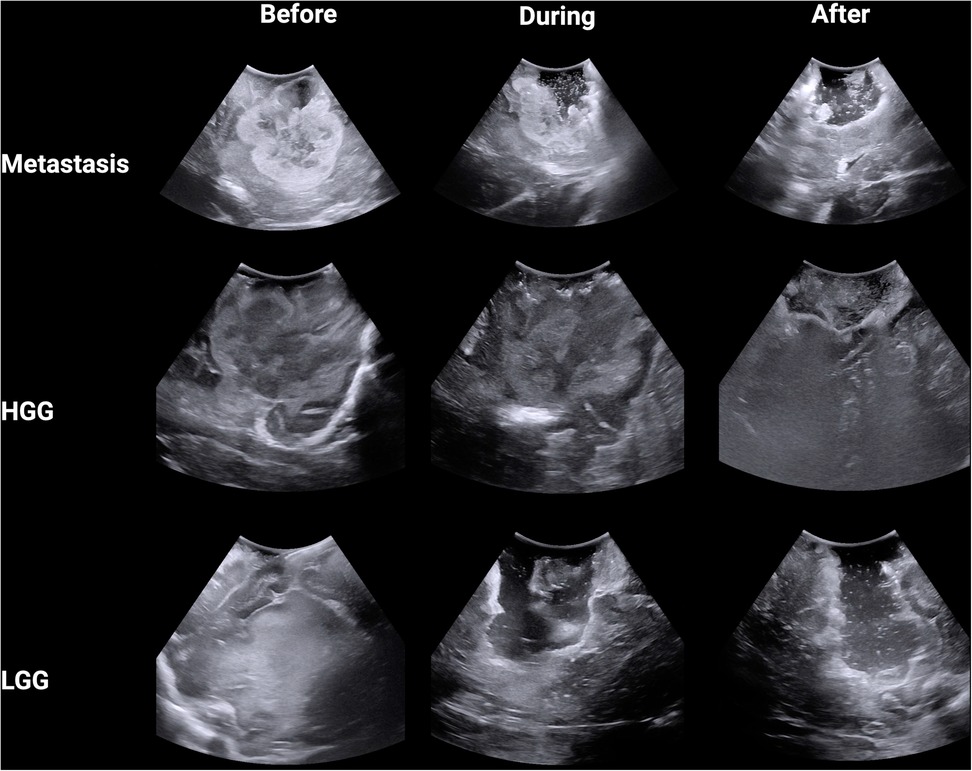 Ultrasound images showing three rows labeled Metastasis, HGG, and LGG, with three columns labeled Before, During, and After. Each cell displays an ultrasound image illustrating the progression or treatment at each stage for the conditions Metastasis, High-Grade Glioma (HGG), and Low-Grade Glioma (LGG).