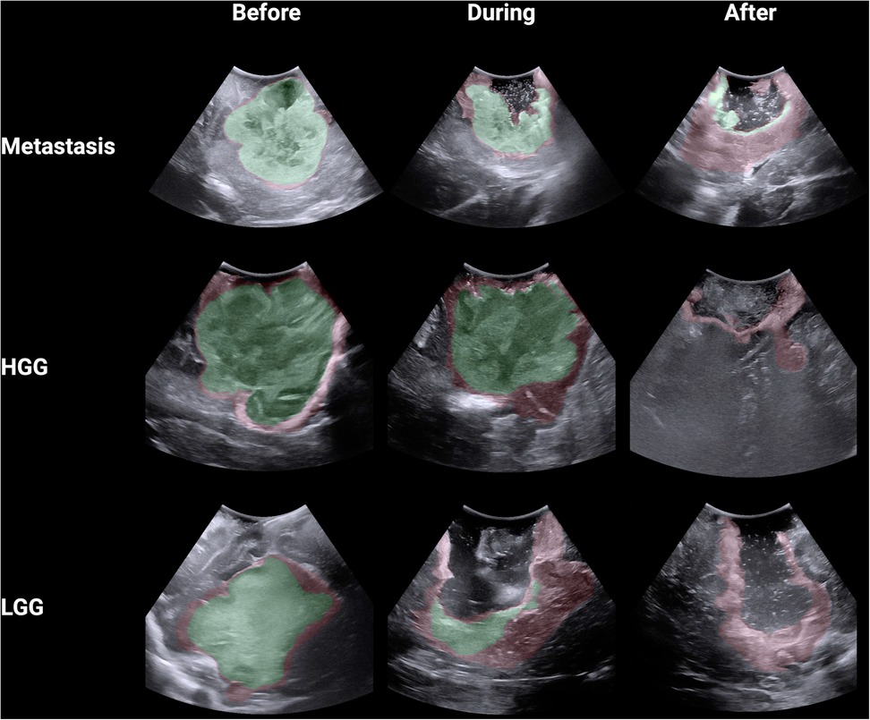 Ultrasound images of brain tumors shown in three stages: before, during, and after treatment. The top row depicts metastasis, the middle row shows high-grade glioma (HGG), and the bottom row represents low-grade glioma (LGG). Tumor areas are highlighted in green indicated greater than 90% agreement and the areas in red indicate 20%-79% agreement.