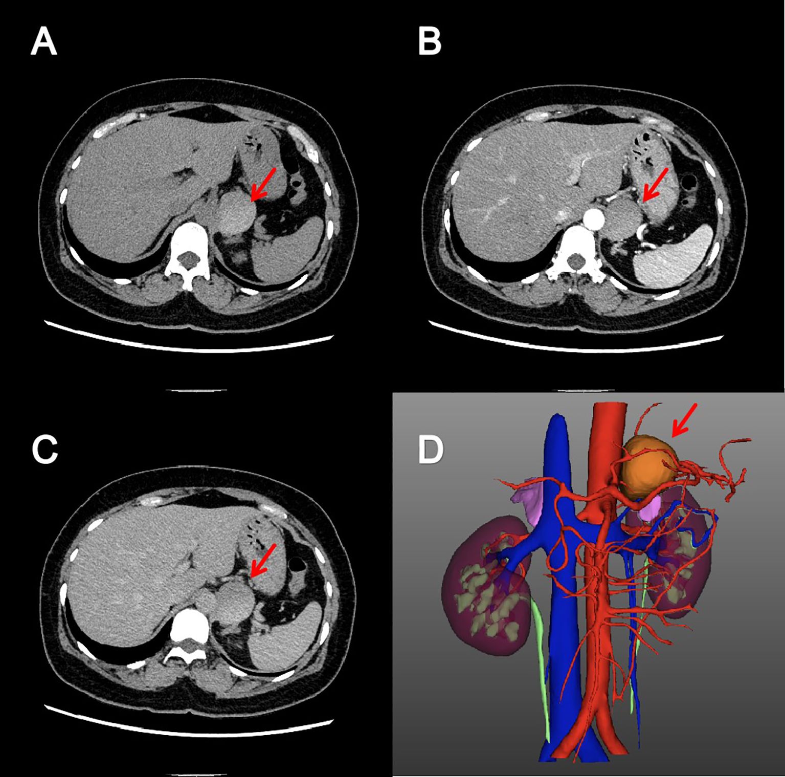 CT scans labeled A, B, and C show cross-sectional abdominal views with red arrows indicating a specific area of interest. Image D is a 3D anatomical model highlighting blood vessels and organs, with an arrow pointing to a notable structure.