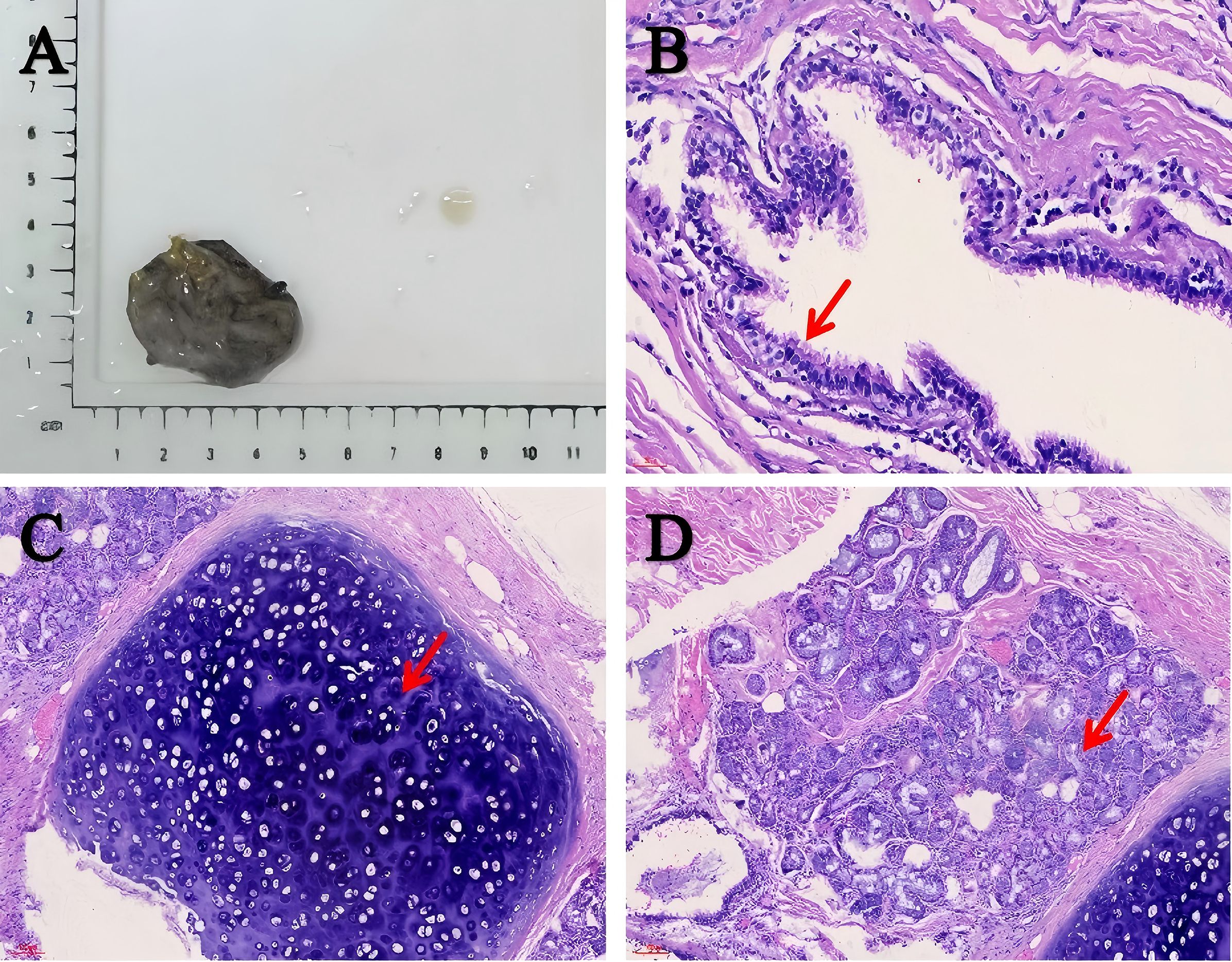 Four-panel image showing a specimen and stained histological sections. Panel A displays a dark stone-like object and a smaller translucent object with a ruler for scale. Panel B shows a tissue section with an arrow pointing to a specific cell layer. Panel C highlights a dense cluster of cells with another arrow. Panel D illustrates a tissue section with various cell types, marked by an arrow. Each panel is labeled A through D.