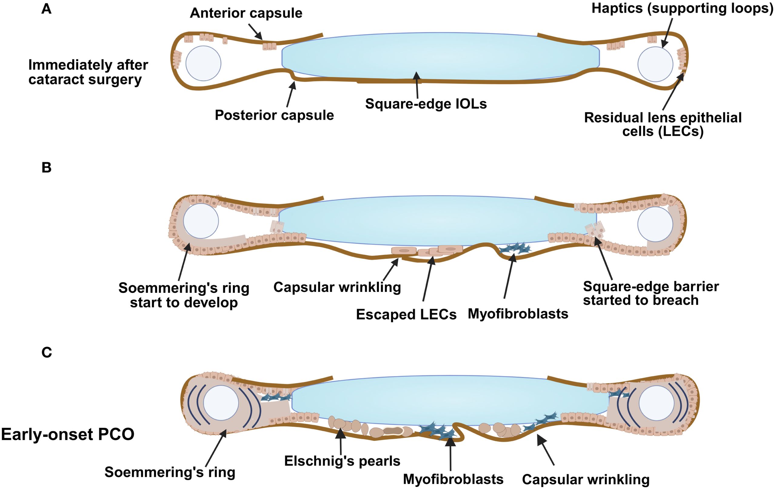 Diagram showing the progression of posterior capsule opacification (PCO) after cataract surgery. Panel A illustrates the immediate post-surgery state with anterior and posterior capsules, square-edge IOLs, haptics, and residual lens epithelial cells (LECs). Panel B shows developing signs of PCO, including capsular wrinkling, escaping LECs, myofibroblast presence, and a breached square-edge barrier. Panel C depicts early-onset PCO with Soemmering's ring, Elschnig's pearls, myofibroblasts, and significant capsular changes.