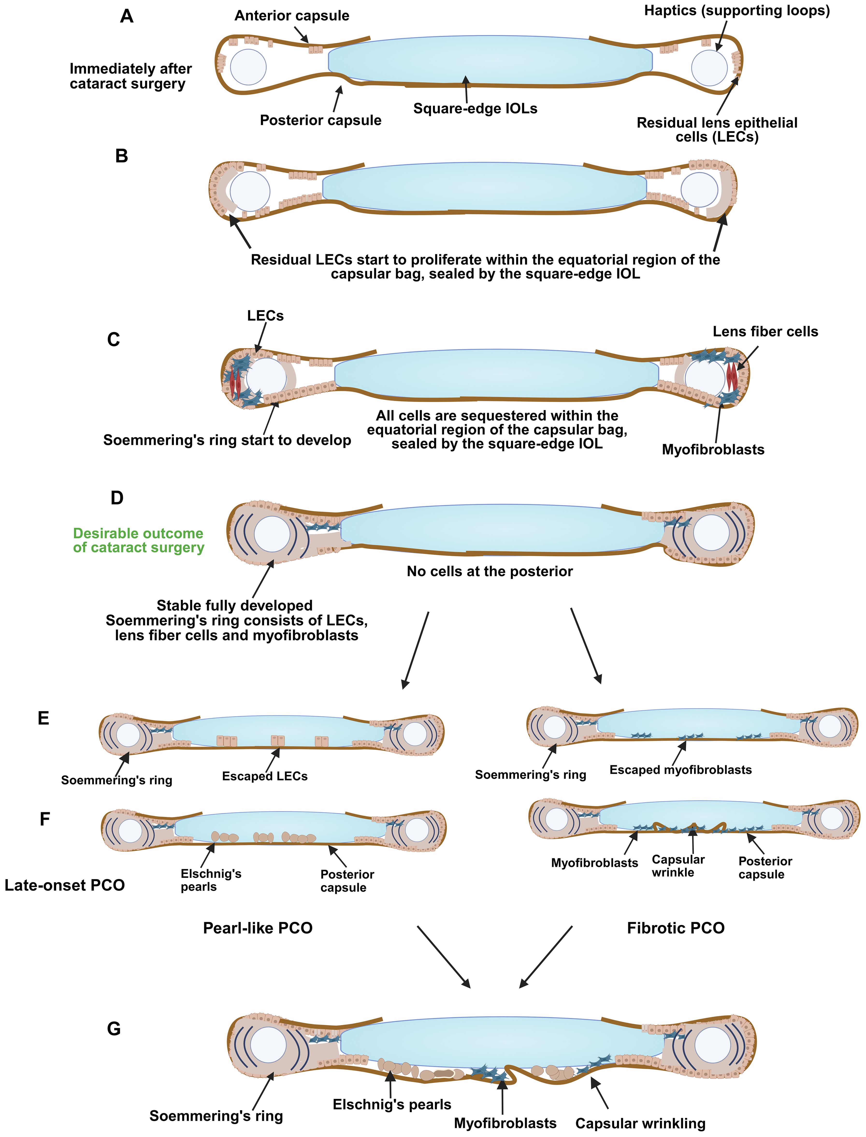 Diagram showing the development of posterior capsule opacification (PCO) after cataract surgery. Panels A to G illustrate the progression from surgery to different PCO stages, including lens epithelial cell (LEC) proliferation, Soemmerring's ring formation, and the occurrence of pearl-like and fibrotic PCO. Labels indicate components like the posterior capsule, lens fiber cells, and myofibroblasts, highlighting the spread and consequences of escaping LECs and myofibroblasts leading to PCO with capsular wrinkles.