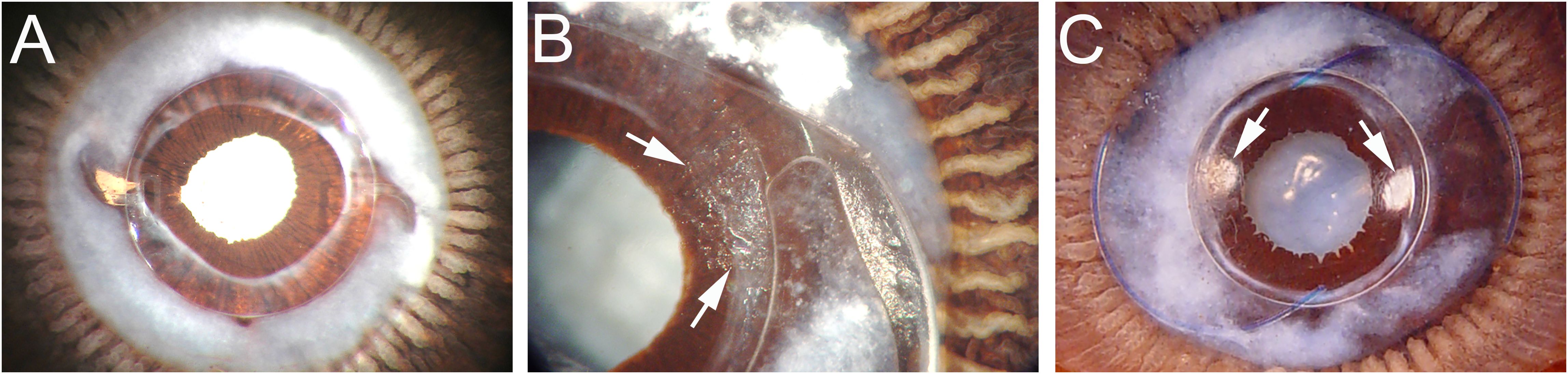 Three-panel gross Miyake-Apple images of a eyes from human cadavers subjected to cataract surgery approximately 2 years prior to death. Panel A shows a clear posterior capsule with a well formed Soemmering's ring.Panel B shows the haptic/optic junction of the IOL with arrows showing cells migrating onto the posterior capsule. Panel C shows a capsular bag implanted with a square edge IOL with Soemmering's ring and the arrows show the formation of peripheral PCO on opposite sides of the lens.