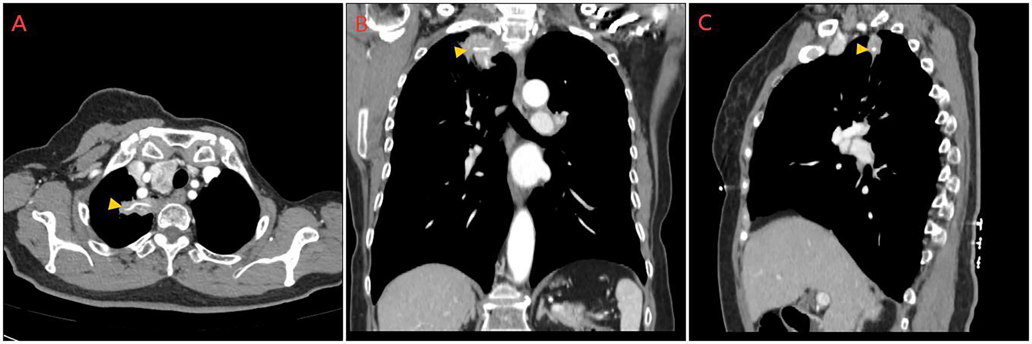 CT scan images in three views: axial (A), coronal (B), and sagittal (C). Each image highlights a specific area within the thoracic region using a yellow arrowhead. The scans reveal structures and tissues, displayed in varying shades of black and white, indicating different densities.