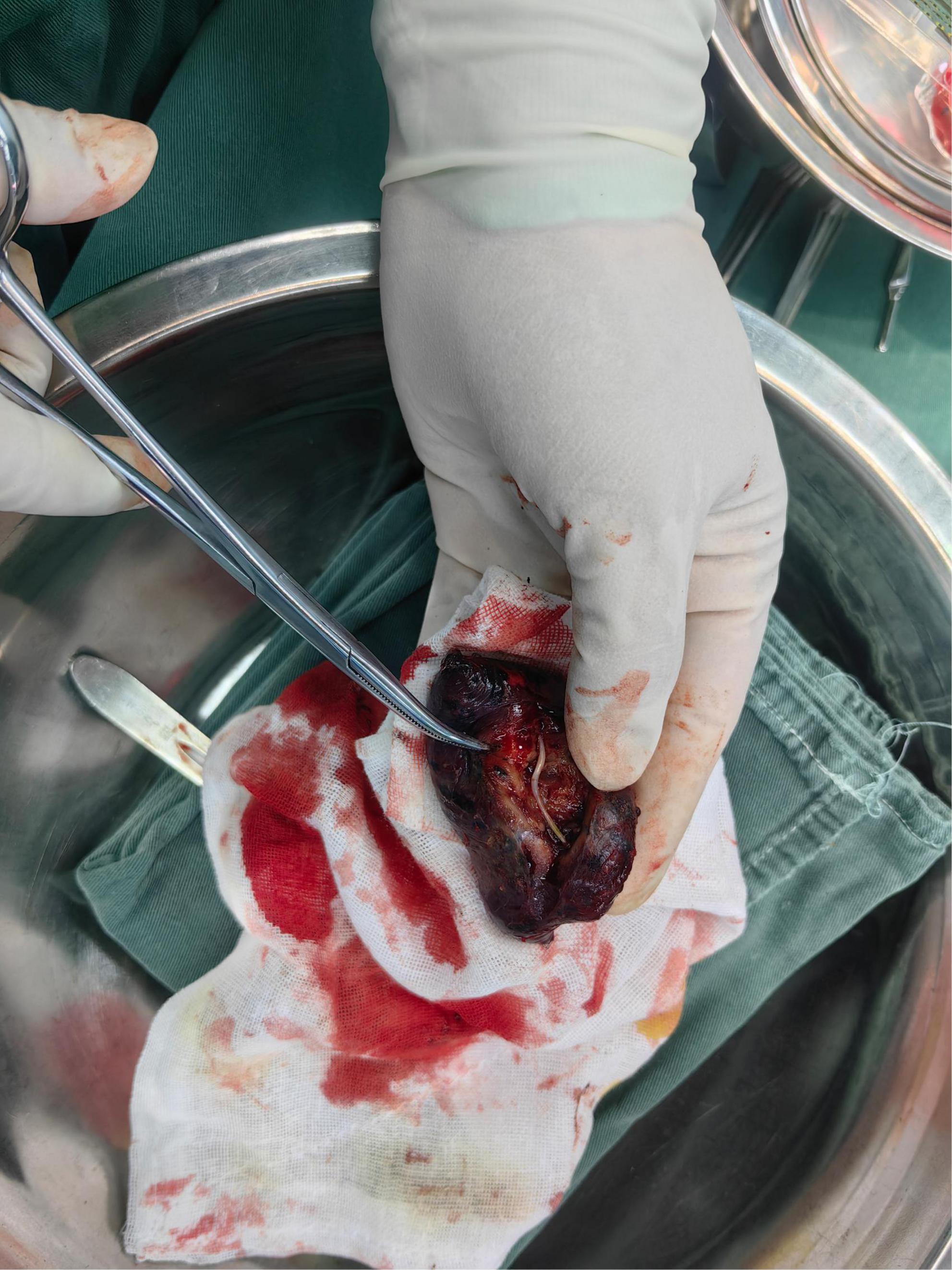 Gloved hands holding a surgical instrument and removing a dark, possibly medical specimen from a blood-stained cloth, placed over a metal tray. Medical tools surround the setup.