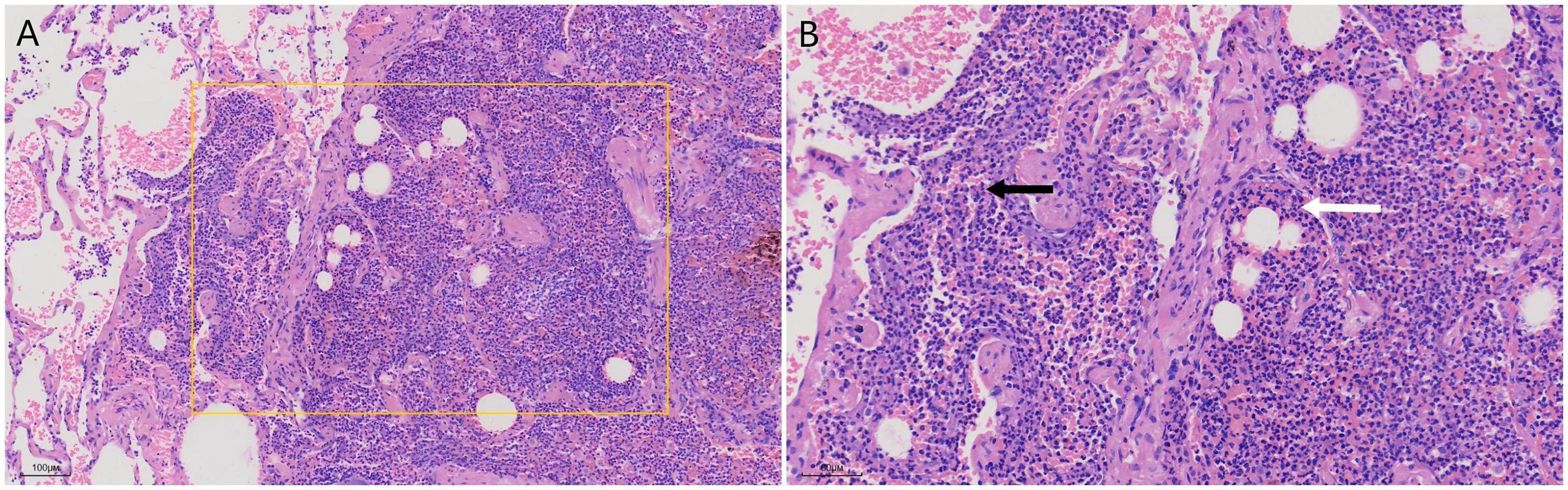 Histological analysis displaying two panels: Panel A shows lung tissue with a yellow rectangle highlighting an area of interest. Panel B, a close-up of the highlighted region, reveals dense inflammatory infiltration. Arrows indicate specific structures within the tissue.