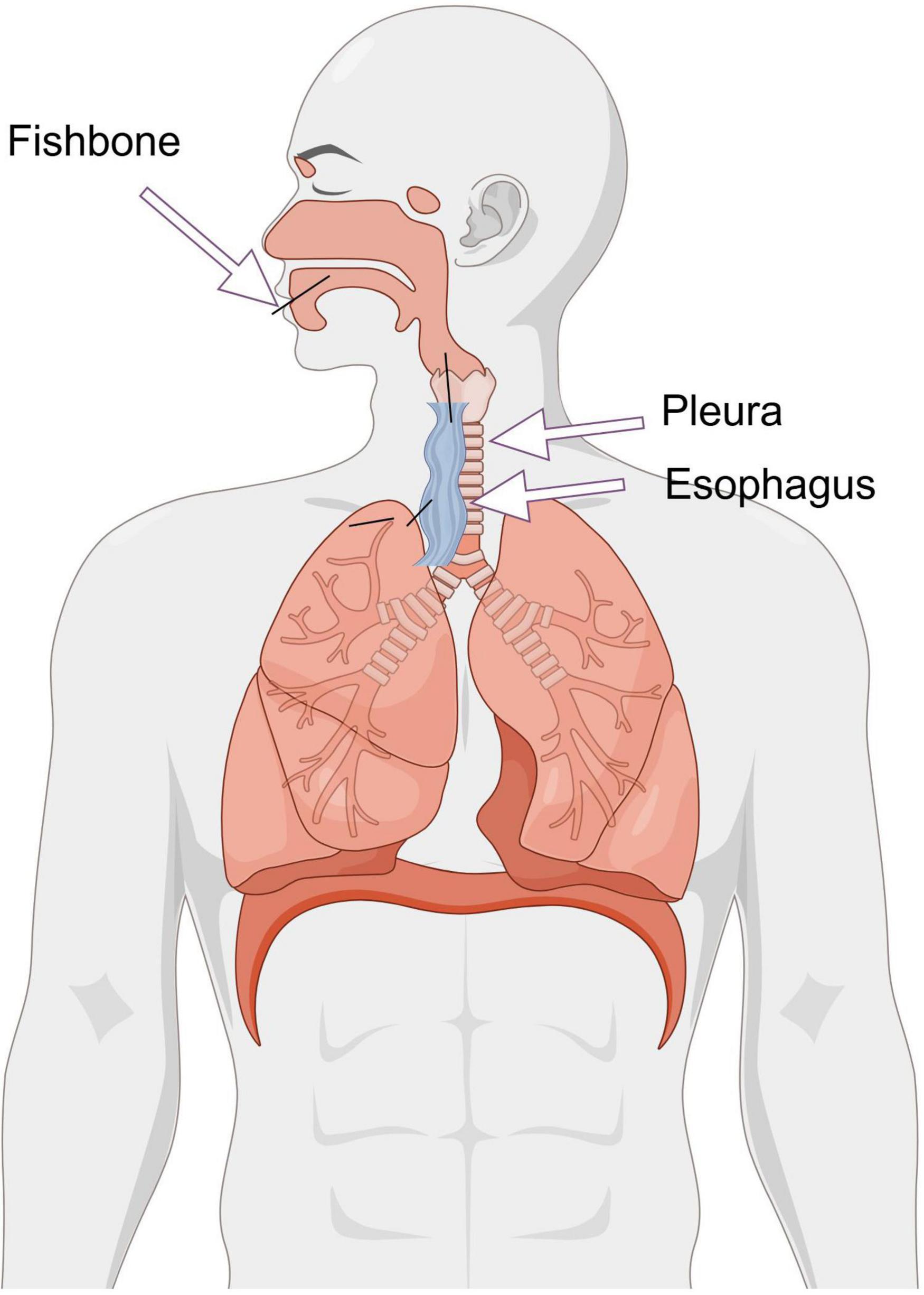 Diagram showing a human torso highlighting the respiratory and digestive systems. Labels indicate the location of a fishbone near the esophagus and pleura. The lungs and diaphragm are also visible.