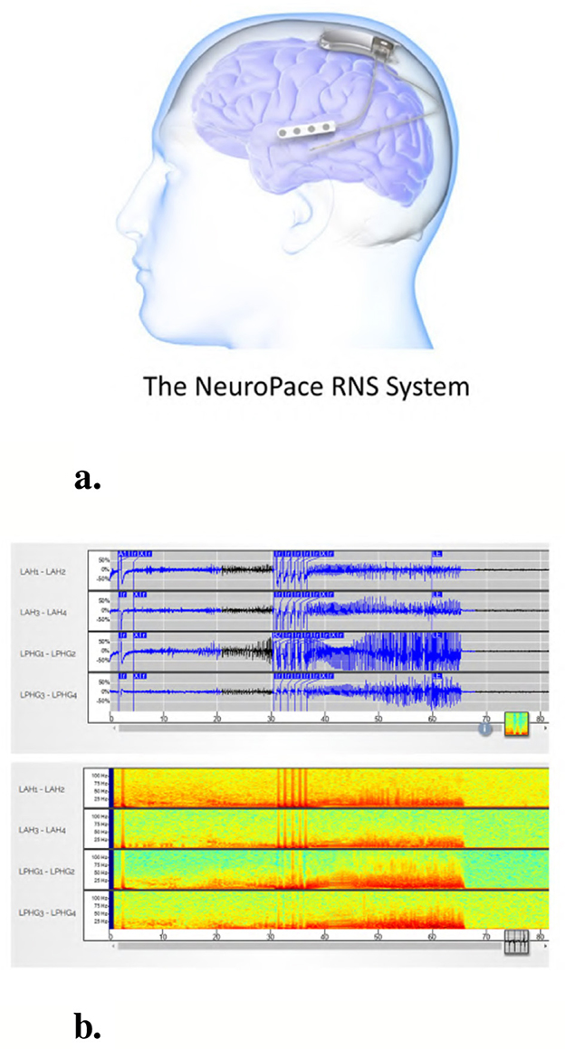 Illustration of the NeuroPace RNS System in a brain, highlighting an implanted device. Below are two graphs: a) displays EEG waveforms with different channels, showing electrical activity over time. b) presents a spectrogram with color gradients, indicating frequency intensity across the same channels.