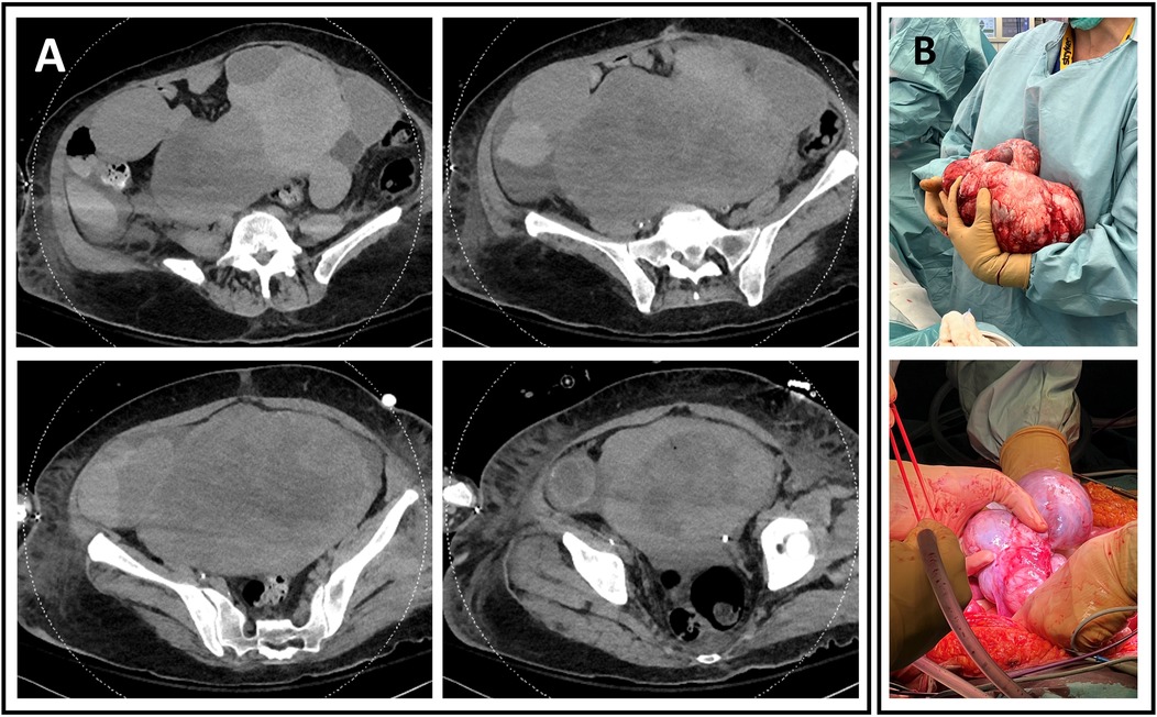 CT scans (Panel A) show axial views of abdominal and pelvic regions with varying densities. Panel B includes two images: a medical professional holding a large extracted mass, and a surgical view of a team operating on a similar mass.