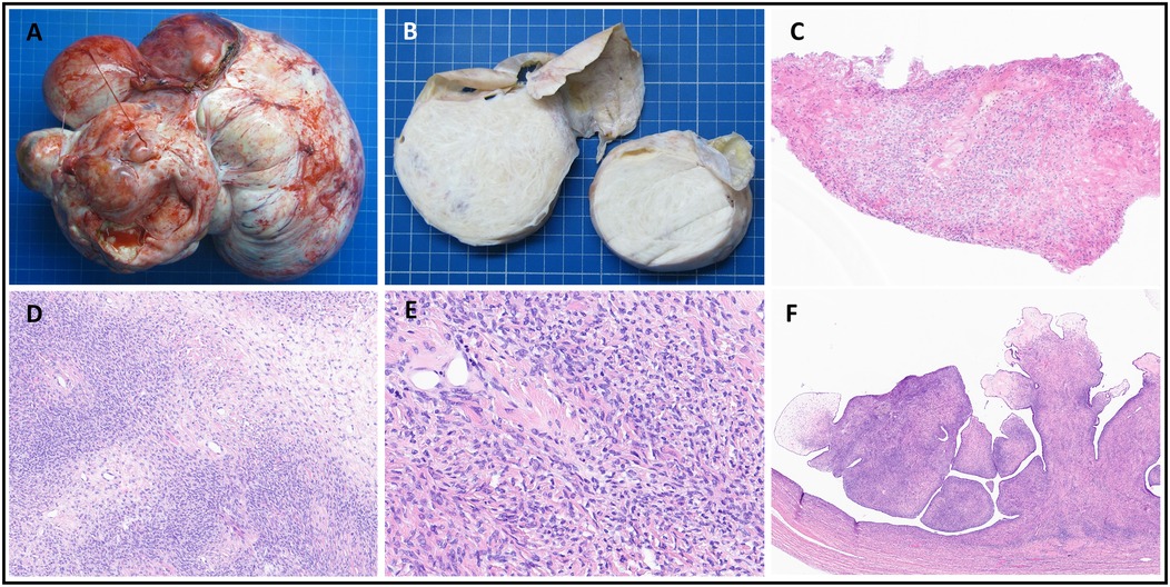 Composite figure showing gross and microscopic pathology of a tumor. Panel A displays a lobulated, fleshy tumor mass with hemorrhagic areas on a blue background. Panel B shows the cut surface, revealing solid, pale, and whorled appearance. Panels C–F present histopathological sections stained with hematoxylin and eosin: C shows a low-power view with cellular proliferation beneath surface epithelium; D and E show higher magnification images of spindle-shaped tumor cells with elongated nuclei in fascicular arrangement; F shows a low-power view of a papillary lesion with fibrovascular cores lined by epithelial cells.
