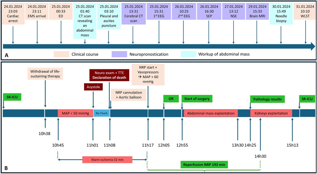 Timeline diagram of a medical case with two sections labeled A and B. Section A depicts events from cardiac arrest on January 24, 2024, through clinical, neuroprognostication, and abdominal mass workup until January 31, 2024. Section B details surgical procedures and timelines in an ICU setting, including withdrawal of therapy, declaration of death, surgery, and reperfusion. Key timestamps are highlighted along horizontal timelines with color-coded phases for clarity.