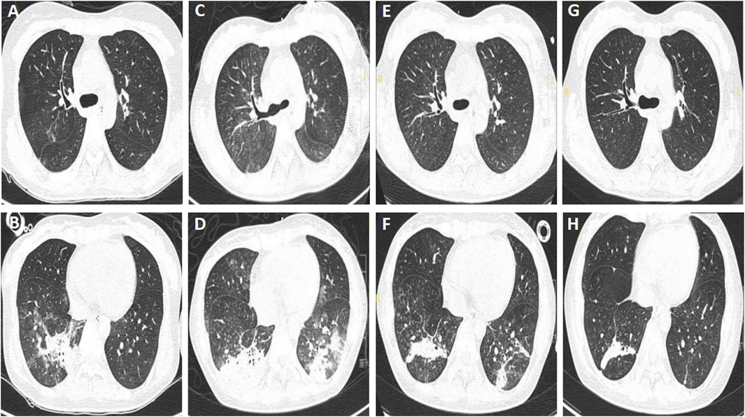 CT scans of the chest in eight panels labeled A to H. Panels A, C, E, and G dispaly relatively clear upper lungs, while panels B, D, F, and H show areas with noticeable abnormalities or opacities in lower lungs, indicating potential pathological changes.
