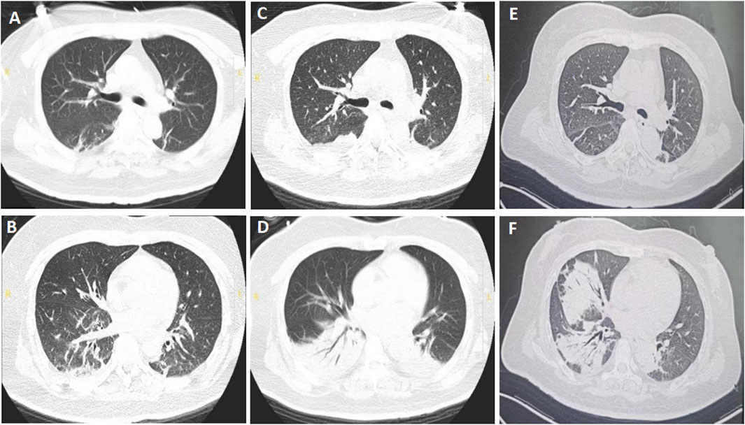 CT scan images showing axial lung sections labeled A to F. Each panel displays varying views of lung tissue with visible structures such as bronchi and blood vessels. Differences in tissue density and potential abnormalities are observed across images.