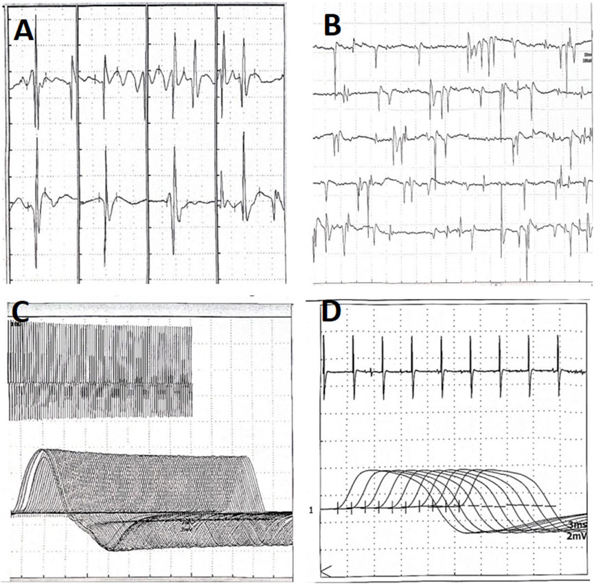 Graphs A and B display electromyography readings with multiple spikes and fluctuations. Graph C shows nonenhanced high-frequency RNS, and graph D illustrates nonattenuated low-frequency RNS.