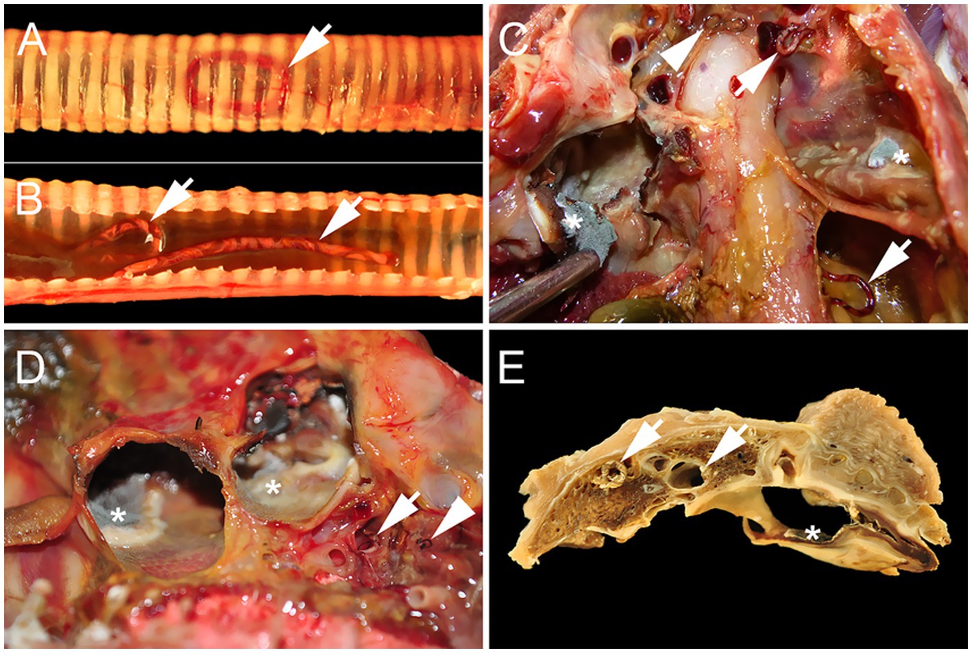 Syngamid and Aspergillus co-infection in a Harris’s Hawk (Parabuteo unicinctus). The trachea contains dark red worms, some with an undulating white line forming a barber-pole pattern. Air sac membranes are thickened, opaque, and brownish-black with white to gray fungal sporulation and mycelia. Large female worms with a barber-pole pattern and smaller uniformly dark red male worms are present in the trachea and air sacs. A transverse section shows consolidated lung tissue with female worms in primary and secondary bronchi and thickened air sacs containing fungal mycelia.