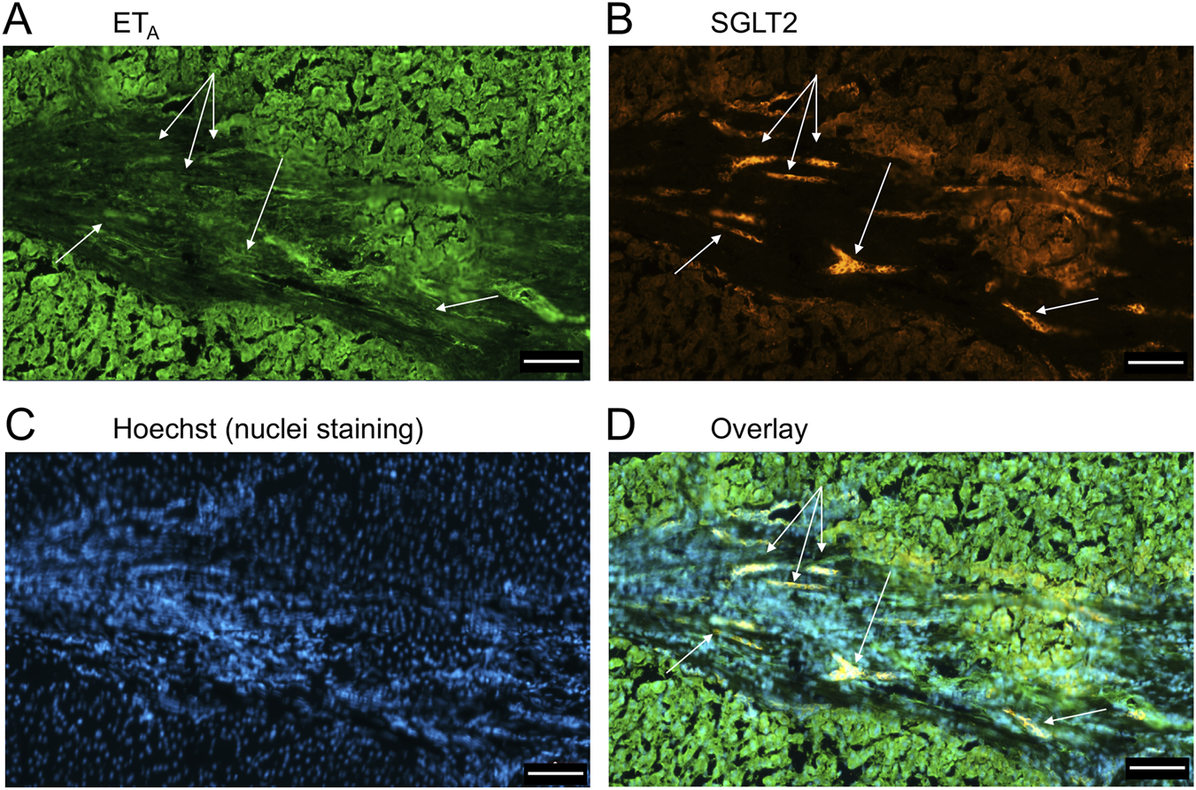 Fluorescence microscopy images with four panels. Panel A shows ETa proteins in green. Panel B displays SGLT2 proteins in orange. Panel C depicts nuclei stained with Hoechst in blue. Panel D overlays these images, combining green, orange, and blue colors. Arrows indicate areas of interest in each panel.