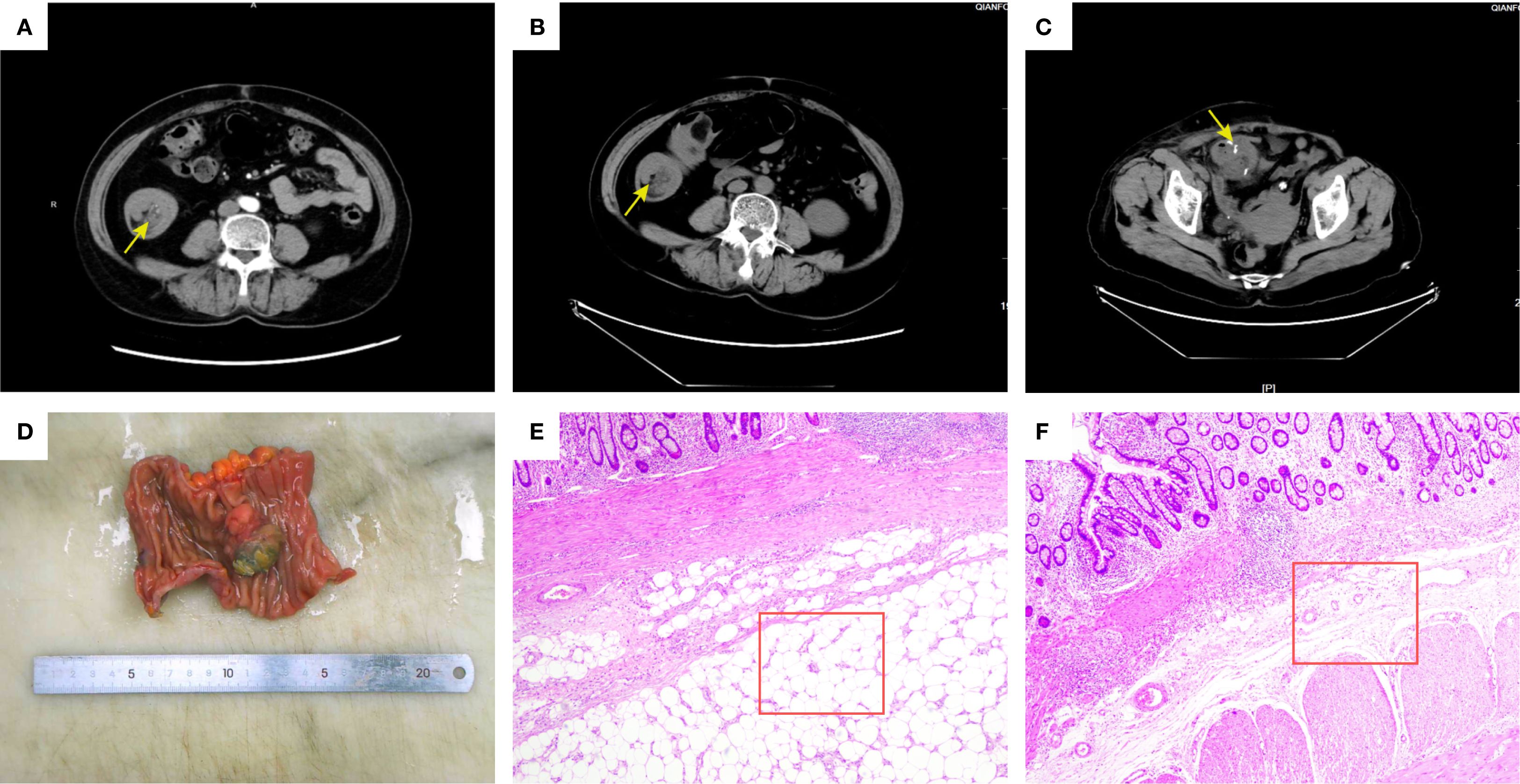 CT images (A, B, C) showing abdominal cross-sections with yellow arrows indicating abnormalities. Image D shows a section of dissected intestine with a green lesion next to a measuring ruler. Images E and F are histological slides highlighting tissue samples with red boxes indicating regions of interest.