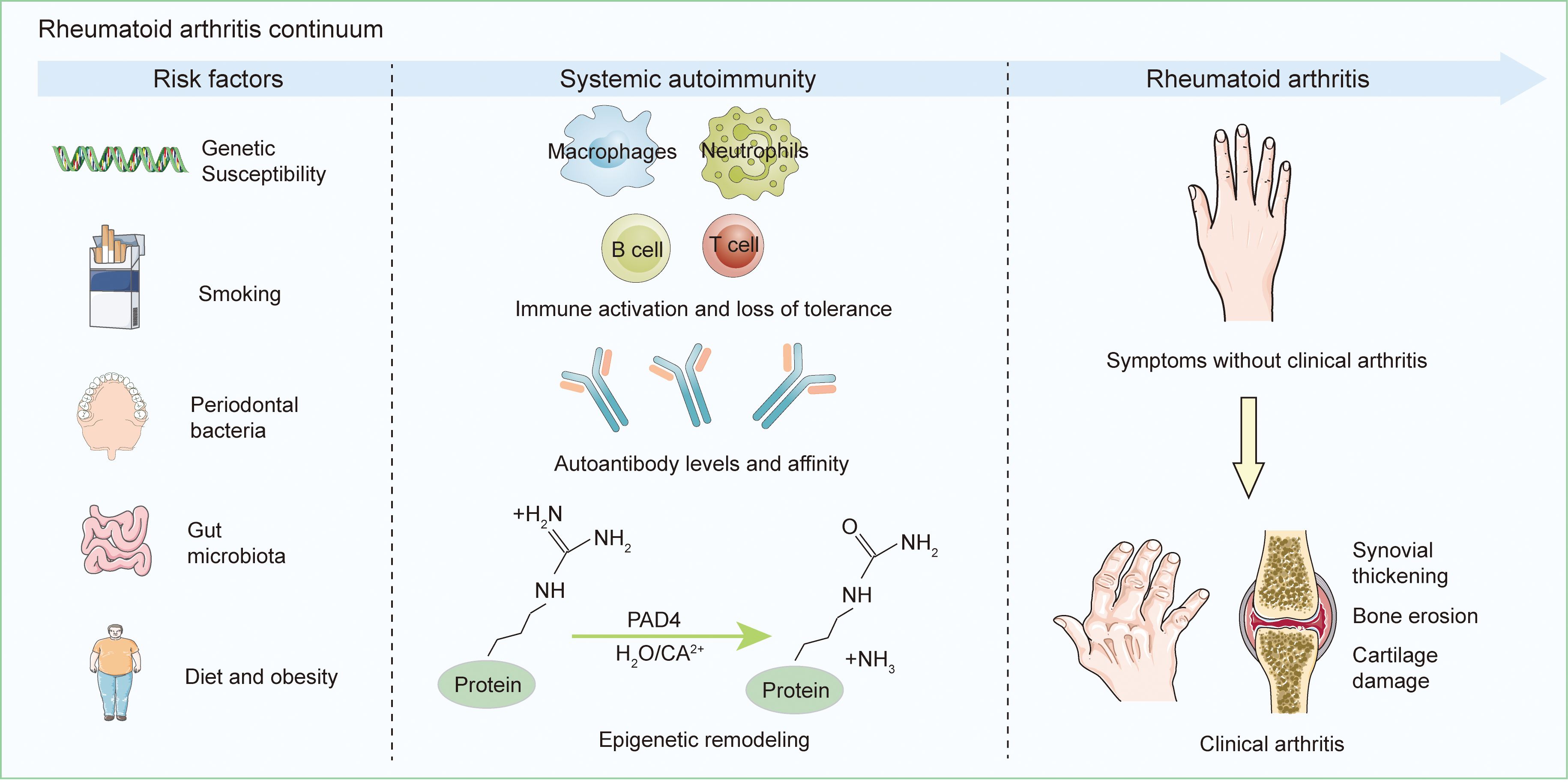 Flowchart depicting the initiation and advancement of rheumatoid arthritis.It results from genetic predisposition and environmental exposures, leading to systemic autoimmunity. RA-related antibodies are initially produced locally in mucosal tissues like the oral, lung, or gut mucosa. Many individuals then progress through a stage of subclinical synovitis before developing overt RA. However, this progression is not inevitable: ACPA positivity may revert to negative before synovitis onset, and some ACPA-positive individuals may never develop RA.