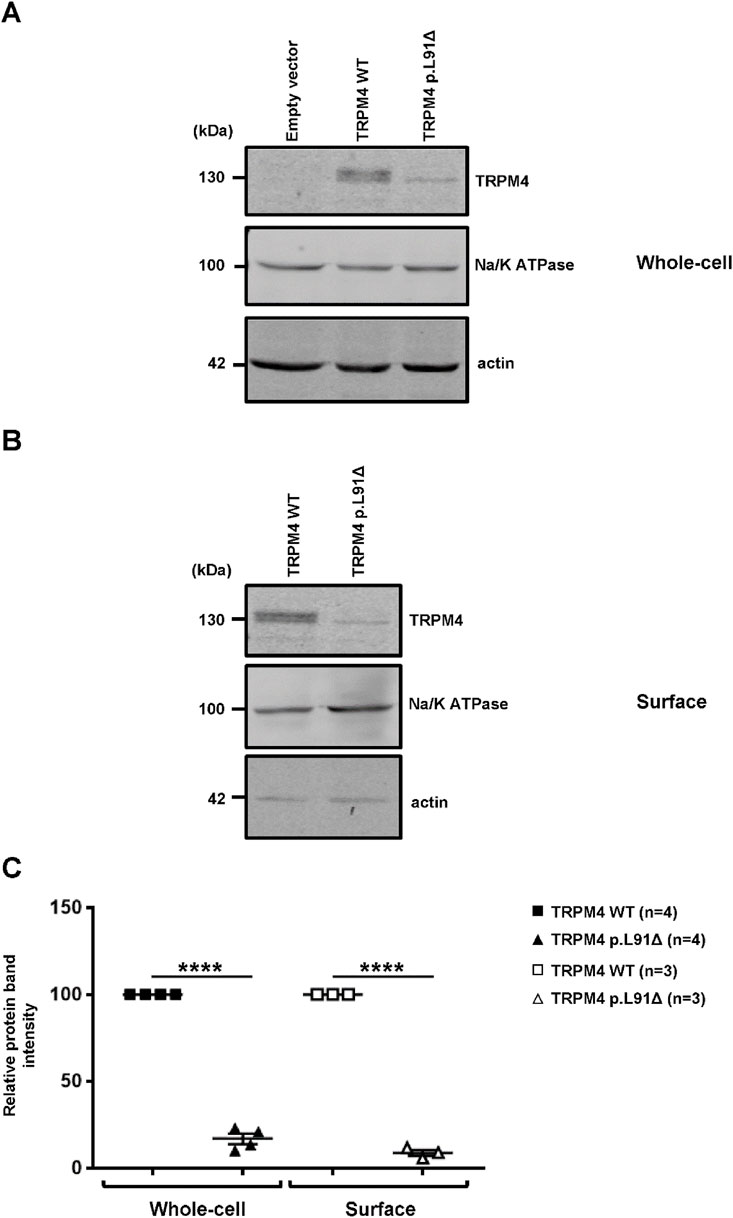 Western blot and graph comparing TRPM4 protein expression. (A) and (B) show protein levels in whole-cell and surface samples. Proteins TRPM4, Na/K ATPase, and actin are indicated with bands. (C) shows a graph of relative protein band intensity, indicating significantly higher expression for TRPM4 WT compared to TRPM4 p.L91Δ in both conditions, denoted by asterisks for statistical significance.