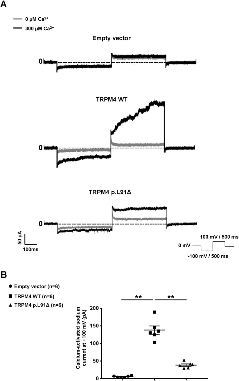 Panel A shows calcium-activated sodium currents in empty vector, TRPM4 wild type, and TRPM4 p.L91Δ under 0 µM and 300 µM calcium concentrations, with noticeable current increases in the TRPM4 WT at 300 µM. Panel B is a scatter plot comparing calcium-activated sodium currents at +100 mV for the empty vector, TRPM4 WT, and TRPM4 p.L91Δ, with significant differences noted between the groups.